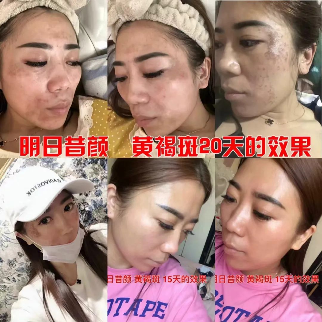 黄褐斑20天效果.jpg